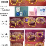 ふ　フッ化物による虫歯の進行抑制　001　2015-0827